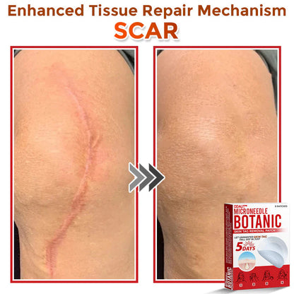 🌈 ODALIT™MicroNeedle Botanic Skin Tag Removal Patch