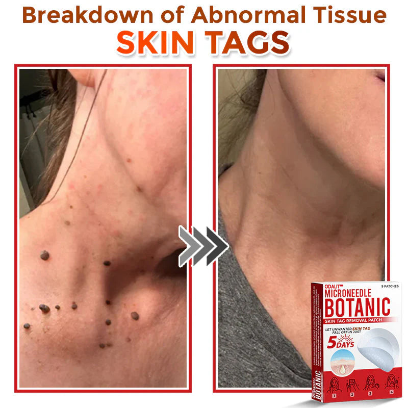 🌈 ODALIT™MicroNeedle Botanic Skin Tag Removal Patch