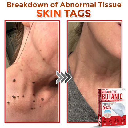 🌈 ODALIT™MicroNeedle Botanic Skin Tag Removal Patch