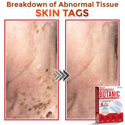 🌈 ODALIT™MicroNeedle Botanic Skin Tag Removal Patch