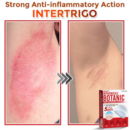 🌈 ODALIT™MicroNeedle Botanic Skin Tag Removal Patch