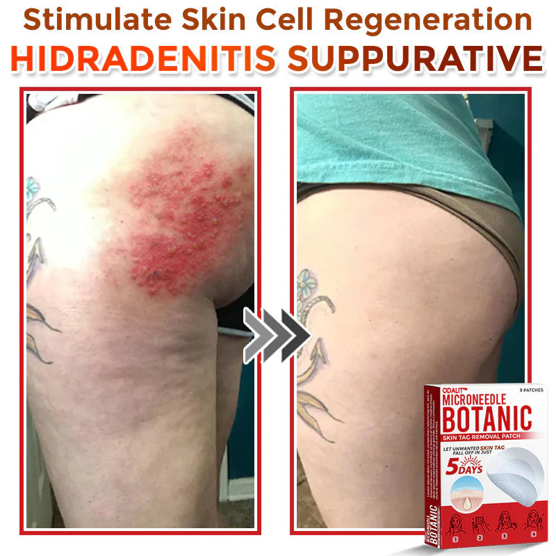 🌈 ODALIT™MicroNeedle Botanic Skin Tag Removal Patch