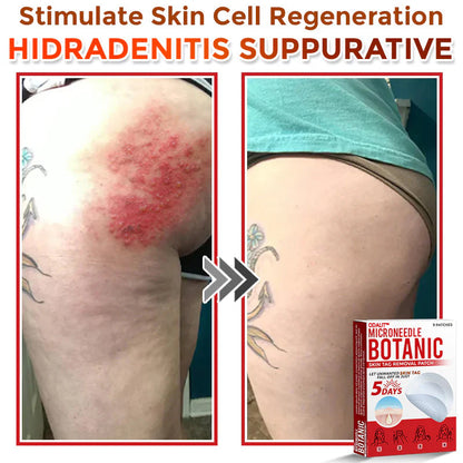 🌈 ODALIT™MicroNeedle Botanic Skin Tag Removal Patch