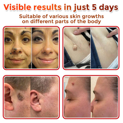 🌈 ODALIT™MicroNeedle Botanic Skin Tag Removal Patch
