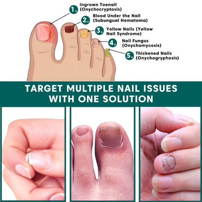 LBMLBM™ Antifungal Pen-UNDECYLENIC ACID25%-Cures Most Athlete's Foot, Jock ltch, andRingworm
